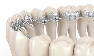 lingual braces lingual braces