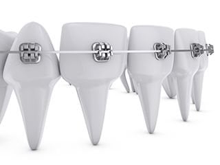 self-ligating braces self-ligating braces