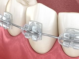 clear braces clear braces