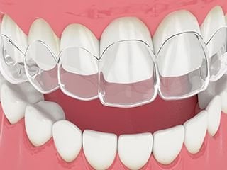 clear aligners clear aligners