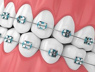metal braces metal braces